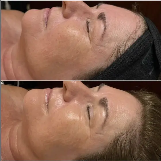 Skin treatment before and after, smoother and more hydrated skin