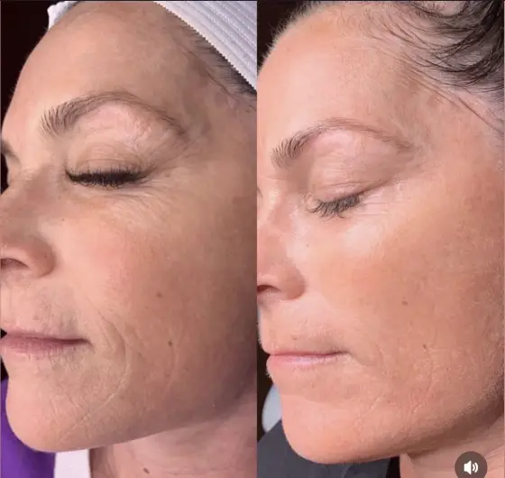 Skin treatment before and after, brighter and more even tone